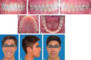 Facial and intraoral photographs after appliance removal. A. Frontal. B. Right side. C. Left side. D. Upper occlusal. E. Lower occlusal. F. Frontal. G. Smile photograph. H. Right profile.