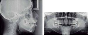 Initial lateral head film, panoramic radiograph and CBCT images.