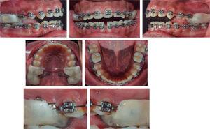 Treatment progress: mini- implants in the palate, between the first and second molars and modified bite-block activated with elastomeric chains.