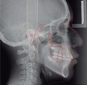Radiografía lateral de cráneo final con estructuras anatómicas.