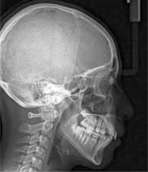 Radiografía lateral de cráneo.