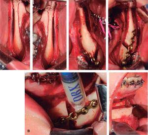 A. Osteotomía sagital mandibular. B. Colocación de injerto ósea. C. Mentoplastia de avance.