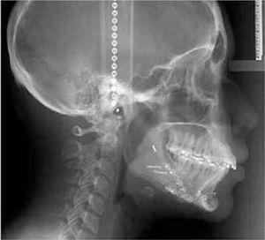 Radiografía lateral de cráneo pos-quirúrgica.