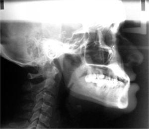 Radiografía lateral de cráneo inicial.