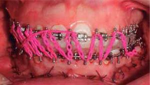 Occlusal splint at the end of surgery.