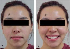 Postsurgical facial photographs: A. Frontal view. B. Smile.