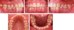 Intraoral final photographs: A. Right side. B. Frontal view. C. Left side. D. Upper arch. E. Lower arch.