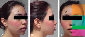 Presurgical facial photographs: A. Right profile. B. Oblique view. C. Vertical proportions.