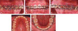 Pre-surgical intraoral photographs A. Right B. Front C. Left D. Upper occlusal E. Lower occlusal.