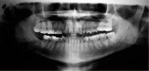 Initial panoramic radiograph, where the presence of 31 teeth may be observed as well as symmetrical condyles, asymmetric height of the mandibular ramus, 2:1 crown-root ratio, retained upper canines, presence of right upper and lower third molars and absence of left upper and lower third molars.