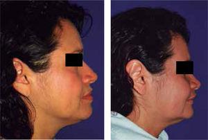 Pre-surgical (left) and post-surgical (right) profile photographs.