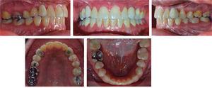Final intraoral photographs after implant placement with their respective prosthetic rehabilitation replacing upper canines.