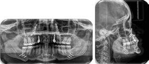 Final panoramic radiograph and lateral headfilm.