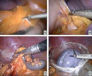 Laparoscopic splenoaneurysmectomy. (A) Cleavage of the splenic angle and opening of the epiplonic transcavity. (B) Section of short gastric vessels. (C) Section of the splenic pedicle using an Endo GIA stapler. (D) Extraction of the surgical piece and placement in a bag.