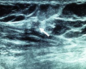 Forearm ultrasonography after 24 months, where the implant can be seen (arrow).