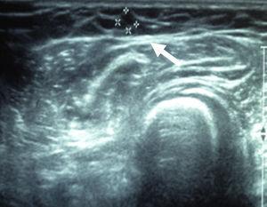 Thyroid ultrasonography after 24 months, where the implant can be seen (arrow).