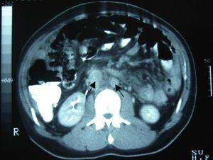 Abdominal computed tomography. Presence of multiple nodular lesions (adenopathy) in the retroperitoneal region, and para-aortic and abdominal lymph nodes (arrows).