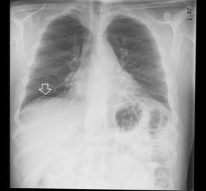 Postero-anterior X-ray imaging of the chest showing right subdiaphragmatic pneumoperitoneum (arrow).
