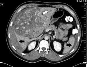 Abdominal axial CT scan with oral and intravenous contrast enhancement in arterial phase which shows liquid fluid in the abdominal cavity, predominantly perihepatic and perissplenic (black arrows) and a rounded tumour, heterogeneously contrasted, which occupies practically the entire liver (white arrow).