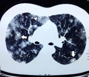 Axial CT scan of the chest, pulmonary window; small solid and rounded tumours are observed, with halos (white arrows), polished glass images (arrow head).