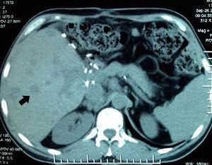 Plain abdominal CT scan. Multiple rounded tumours, which are hypodense in liver graft (black arrow).