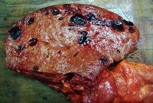 Liver graft with multiple, rounded tumours, characteristically haemorrhagic.