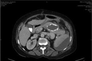 Computed tomography 48h postoperatively revealing hypodense areas involving almost 50% of the splenic parenchyma.