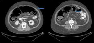 Abdominal tomography with intravenous contrast. Massive dilatation of the ascending and transverse (left) colon can be seen. Intestinal pneumatosis and free air bubbles in close proximity to the colon (right) can be observed.