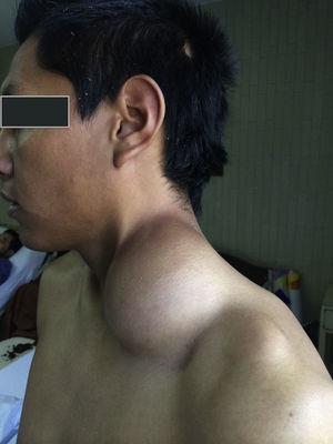 Case 1. Lymphangioma in the left posterior cervical triangle of the neck of approximately 15cm×10cm, with no changes in colour.