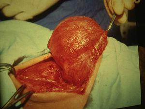 Case 2. Submandibular lymphangioma in the perioperative period.