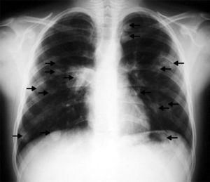 Chest X-ray revealing numerous pulmonary nodules (arrows). Right-sided parahilar infiltrate.