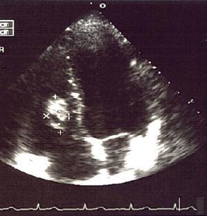 Echocardiogram highlighting a solid nodule (between the crosses) in the right side of the interventricular septum.