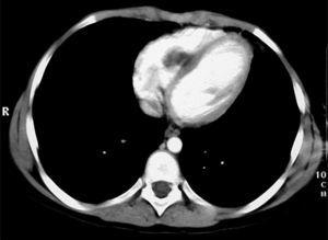 Cardiac nuclear magnetic resonance, showing a nodule in the right side of the interventricular septum.
