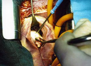 Photograph of cardiac surgery from the head end. Exposure of the cyst through a right ventriculotomy. Puncture-aspiration-injection of the cysts. The Duval clamp is closing the fissured area. The separator is separating the anterior papillary muscle.