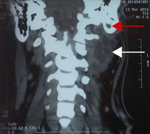 Plano coronal de tomografía computarizada contrastada del cuello que muestra una colección purulenta en los espacios profundos del cuello (flecha blanca) y signos de mastoiditis ipsilateral (flecha roja).