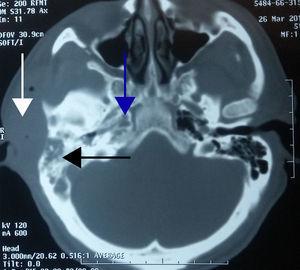  Zeigt den rechten Mastoid (schwarzer Pfeil) und den ipsilateralen petrous Apex, der von einem isodensen Bild (blauer Pfeil) und einem Weichteilabszess (weißer Pfeil) besetzt ist.