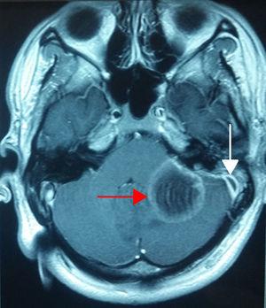 Nuclear magnetic resonance of the skull, axial plane in T1 gadolinium sequentie; toont het cerebellaire abces (rode pijl) en de gezwollen meninx ter hoogte van de linker sigmoid sinus (witte pijl).