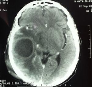 Tomografia computerizzata contrastata del cranio; mostra ascesso cerebrale con edema perilesionale ed edema dei tessuti molli.