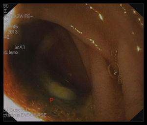 Upper digestive tract endoscopy. P: exposure of Dacron prosthesis through the duodenal lumen.