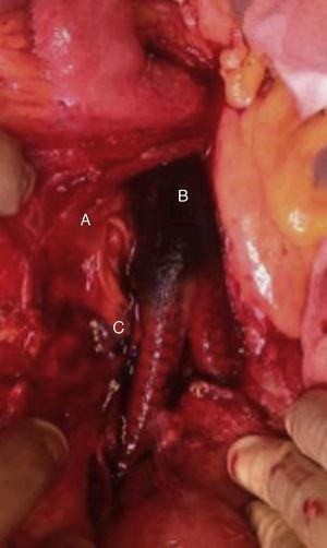 Surgical field, with prosthetic exposure. Letters A, B and C mark the sites where 3 samples were taken during surgery for cultures. These correspond to: (A) the duodenal segment in contact with the prosthesis, (B) the prosthetic segment and (C) the periprosthetic fluid smear.