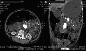 Abdominal tomography with intravenous contrast. (A) Axial slice with findings of dilation of small bowel loops greater than 3cm, and air corpuscles located outside the intestinal lumen (arrows). (B) Coronal slice with major gastric dilatation (black arrow), free air (continuous white arrow) and free fluid in the cavity (dashed white arrow).