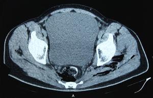Abdominal-pelvic computed tomography: perforation can be observed at the level of the rectal anastomosis.