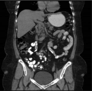 Case 1. Contrasted abdominal tomography, sagittal plane showing the device causing interference (foreign body).