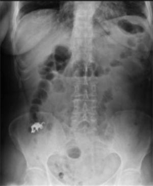 Case 2. AP abdominal X-ray. Image compatible with dental bridge. Day 5 after ingestion.