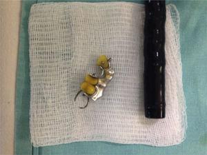 Dental prosthesis with colonoscopy, after its extraction.