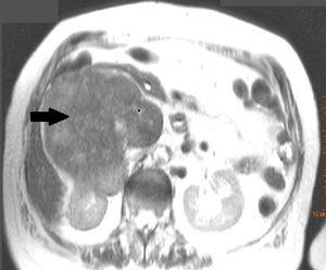 Abdominal axial computed tomography, showing the large retroperitoneal mass enveloping the right kidney and the inferior vena cava.