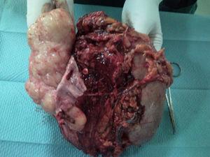 The removed tumour tissue is shown. The partially resected vena cava can be seen to the left of the image completely occupied by tumour.