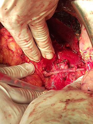 Image of the bypass with saphenous vein between the left renal vein and the proximal stump of the inferior vena cava.