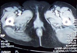 Computed axial tomography. Well-defined mass 8cm×6cm, hypodense with no enhancement after injection of contrast medium into the gluteus maximus.