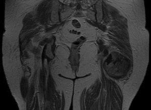 MRI scan. Coronale volgorde.